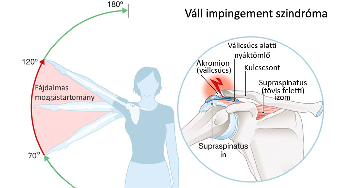 Impingement szindróma (váll ütközési szindróma)