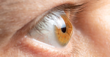 Keratoconus - A szaruhártya elvékonyodása