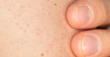 Keratosis pilaris (csirkebőr)