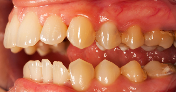 A lepedék és ínygyulladás veszélyei