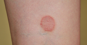 Egy krónikus, gyulladásos bőrbetegség - A lichen planus