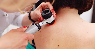 Melanomagyanús anyajegy kimetszése lépésről lépésre