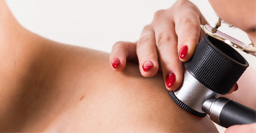 Anyajegy vagy melanoma? Mik a különbségek?