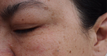 Melasma - Sötét foltok a bőrön
