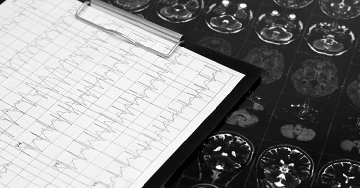 Mit tegyen TIA után, hogy elkerülje a stroke-ot?