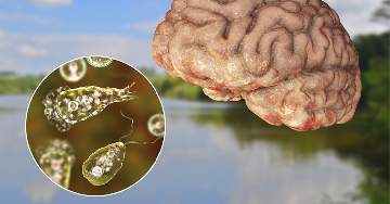 Naegleria fowleri - Primer amőbás meningoencephalitis