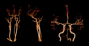 CT-angiográfia