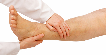 A nyiroködéma okai és kezelése