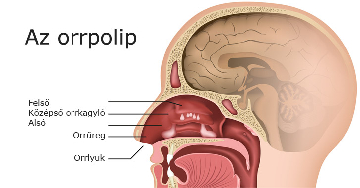 Az orrpolip: okok, tünetek, kezelés és megelőzés