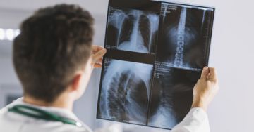 Mi az az osteophyta (csontnövedék)?