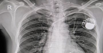 Pacemaker - Mennyire kockázatosak a mobiltelefonok és más eszközök?