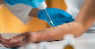 Prick teszt - bőrpróba allergének meghatározására