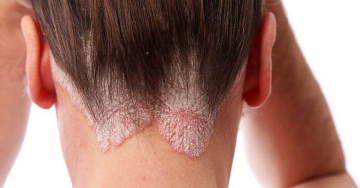 A pikkelysömör (psoriasis) tünetei