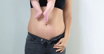 Rectus diastasis - Ártalmasabb, mint hinnénk