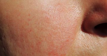 A rosacea - Bőrpír, értágulat, borvirágos orr