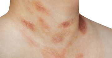 Rózsahámlás (pityriasis rosea)