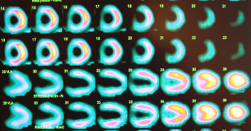 Diagnosztikai módszerek: SPECT