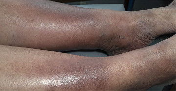 Vénás eredetű bőrgyulladás (stasis dermatitis)