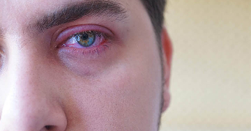 Szemhéjszéli gyulladás (blepharitis)