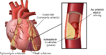 Mi a koszorúér-szűkület?