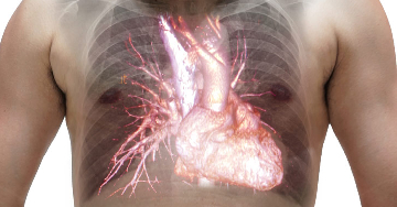 Pulmonális szívbetegség (cor pulmonale)