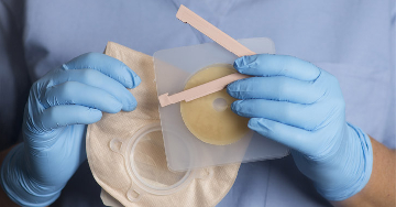 A sztóma ápolása - Mire kell figyelni a mindennapokban?