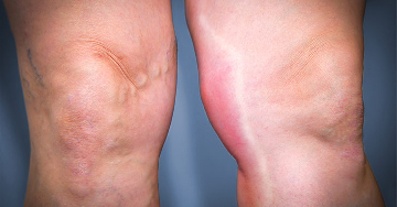 Thrombophlebitis (trombózissal kísért felületi visszérgyulladás)