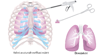 Tüdőbiopszia - Hogyan történik?