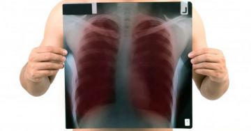 A tuberkulózis (tbc) diagnosztizálása, kezelése és megelőzése