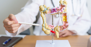 Milyen szövődményekkel járhat a colitis ulcerosa?