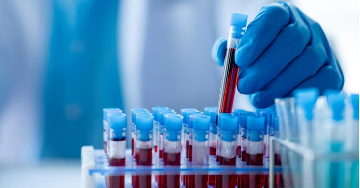 A hasnyálmirigy gyulladására utaló laboreredmények