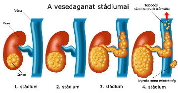 A vesedaganatos betegek életkilátásai