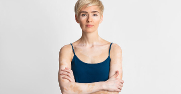 Vitiligo - Egy titokzatos bőrbetegség