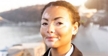 Vitiligo és társbetegségei