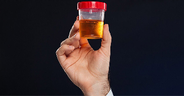 Nephropathia: cukorbetegség és vesekárosodás