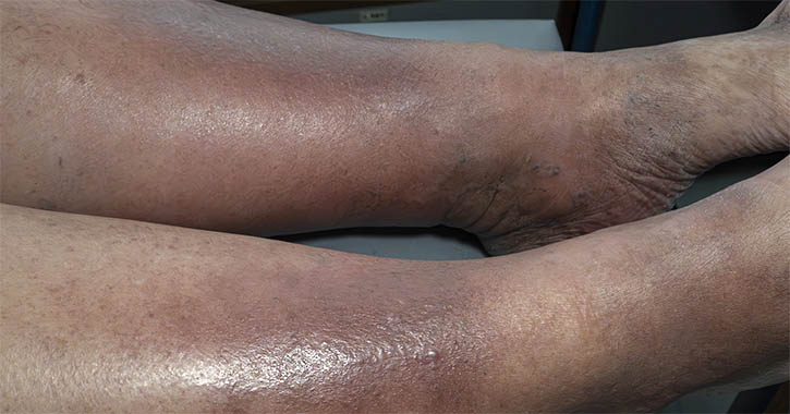 Dermatitis
