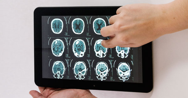 stroke és paraziták férgek megelőzésére szolgáló gyógyszerek