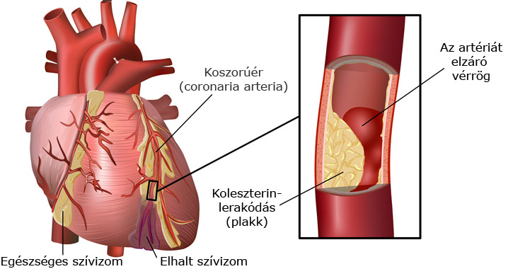 Szív koszorúérmeszesedés, plakk képződése