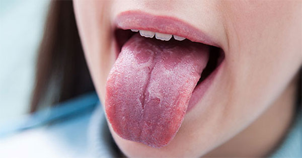 A pikkelysömör a száját és a nyelvét is érintheti