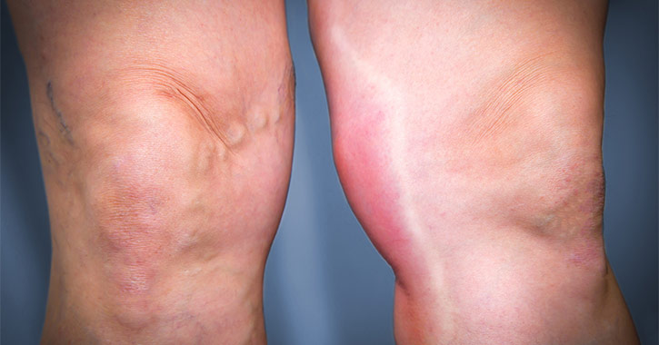 Thrombophlebitis