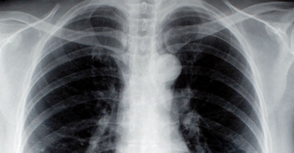 röntgen a tüdőről magas vérnyomás esetén