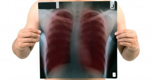 A tuberkulózis (tbc) tünetei és rizikófaktorai