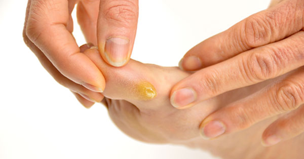 a tyúkszem kezelése a lábujjak ízületein a lábak térdízületei fájnak