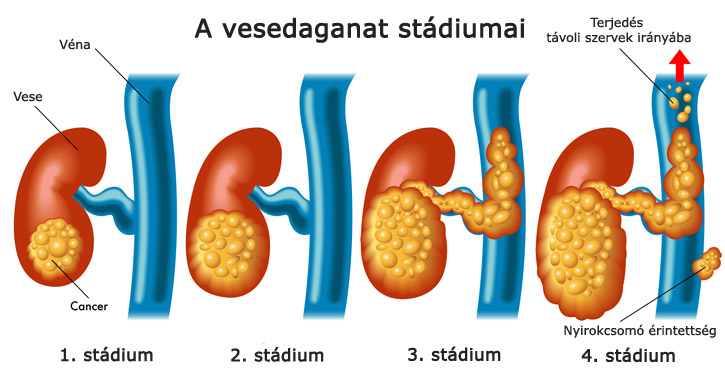 Veserák stádiumai