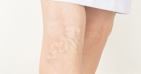 Visszeresség a lábak terhesség alatt A lábak és a visszér bőrbetegségei
