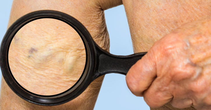 Mélyvénás trombózis