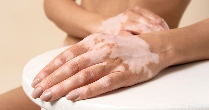 Vitiligo: bőrünk üzenete
