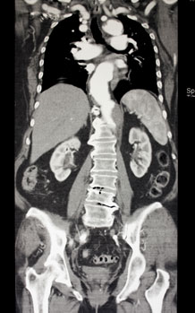 Mi a CT? CT (Computertomograph) kép