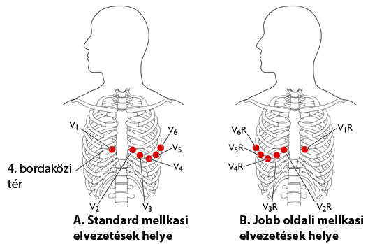 EKG vizsgálat felhelyezés ábra