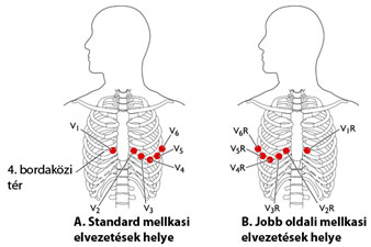 Az EKG elektródák elvezetési helyei